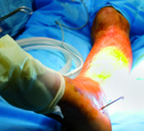 La imagen muestra la pierna de una persona que ha sufrido una intervención quirúrgica