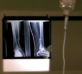 Radiografía de una fractura