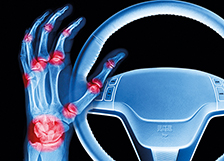Artrosis y conducción